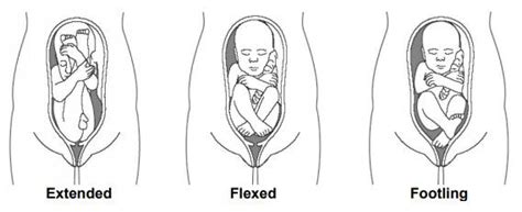 Breech Presentation – What are your choices? - Milton Keynes University Hospital