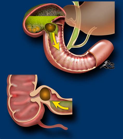 The Radiology Assistant : Gallstone disease - Gallbladder obstruction