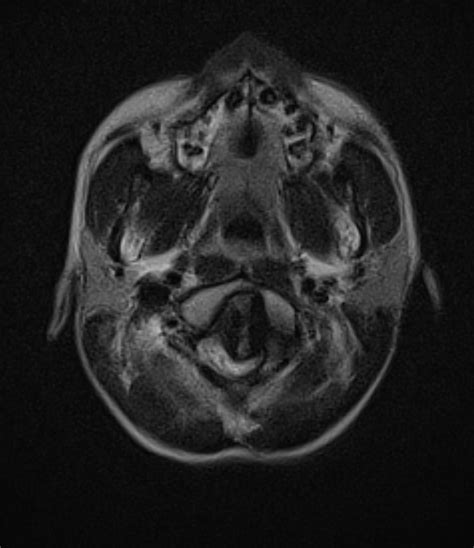 Platybasia and basilar invagination | Image | Radiopaedia.org