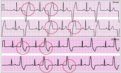 bigeminy | Nursing mnemonics, Ecg nursing, Ekg