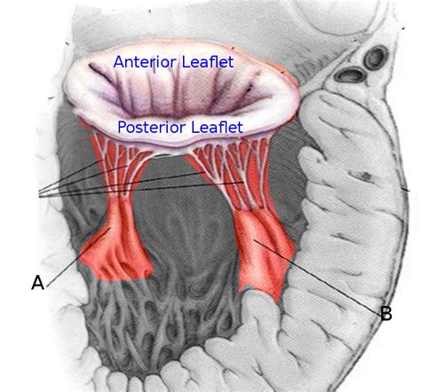 Papillary Muscle Rupture - StatPearls - NCBI Bookshelf