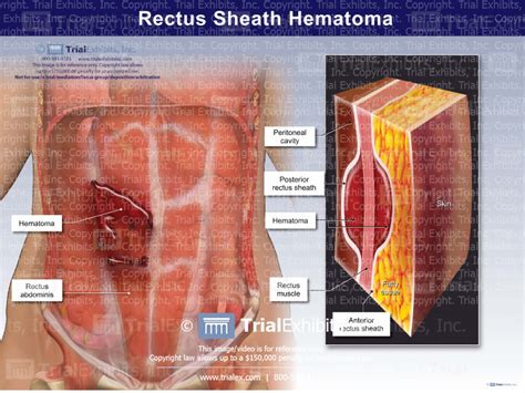 Anterior Rectus Sheath