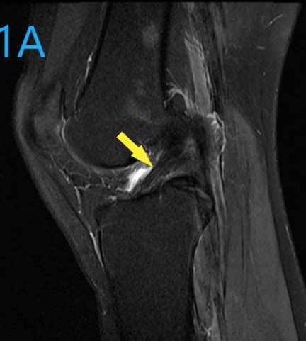 MRI- Finding the Cause of Knee Pain | Rockville MD | Radiology Center