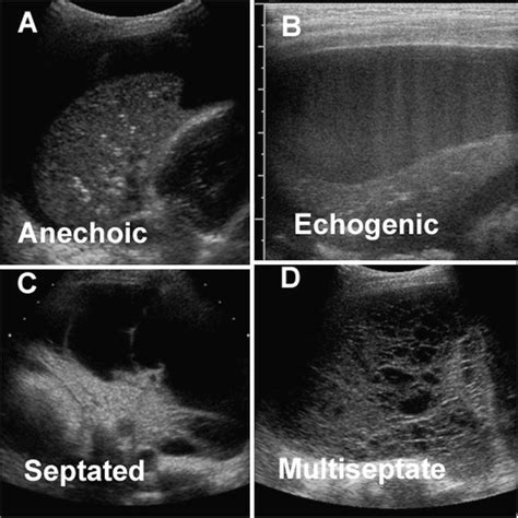 Empyema Drainage | Radiology Key