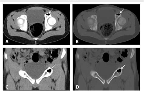 Figure 1 from Incidental intraosseous pneumatocyst with gas-density ...