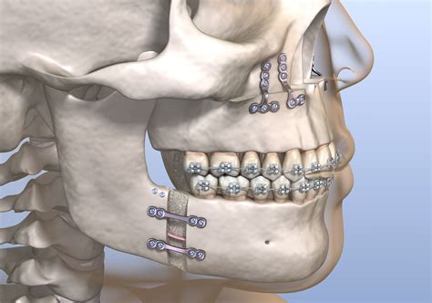 Jaw Surgery l Lancaster, PA l Conestoga Oral Surgery