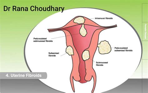 Gynaecology -Fibroid, Endometriosis,Polyp treatment – Dr. Rana Choudhary