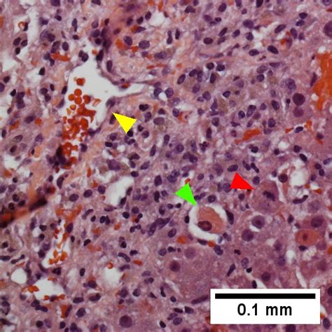 Congestive hepatopathy - Libre Pathology