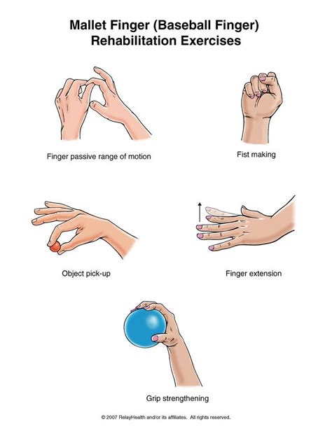 Mallet Finger Physiotherapy Exercises at Ora Rouse blog