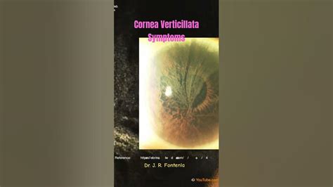 Cornea Verticillata. Symptoms. - YouTube