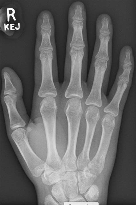 Xray Hand Anatomy