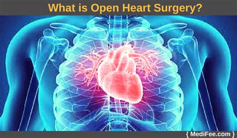 Open Heart Surgery: Complications and FAQs.