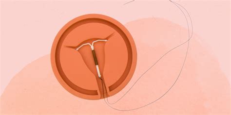 IUD Removal: How It Works and Side Effects to Expect | SELF