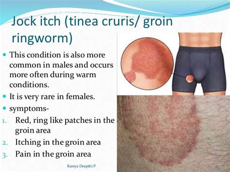 rash in groin area female - pictures, photos