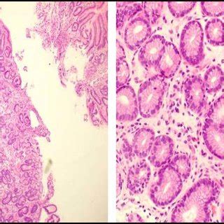 Gastric antrum biopsy: left: chronic inflammation. Right: chronic focal ...