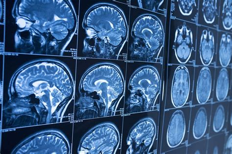 Gadolinium Retention in MRI: What You Need to Know - DMS Health