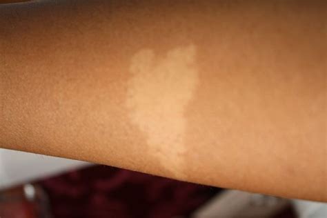 White Birthmark Meaning, On Stomach, Hair, Back, Baby & White Birthmark Removal | BeautyZion ...