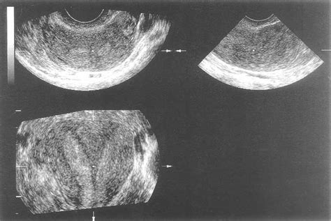 3D ultrasound from a septated uterus. Contrary to case in figure 3, in ...