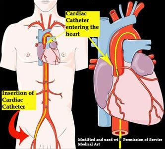 Cardiac Catheterization | Merrimack Valley Cardiology