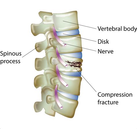 Compression Fractures of the Spine - Dr. Lani Simpson