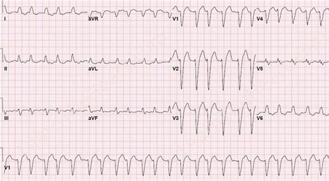 Supraventricular Tachycardia With Aberrancy Ecg Example Learntheheart ...