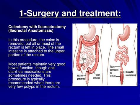 PPT - Colon cancer PowerPoint Presentation, free download - ID:3297970