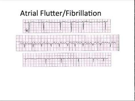 Atrial fibrillation vs flutter - Trosarab