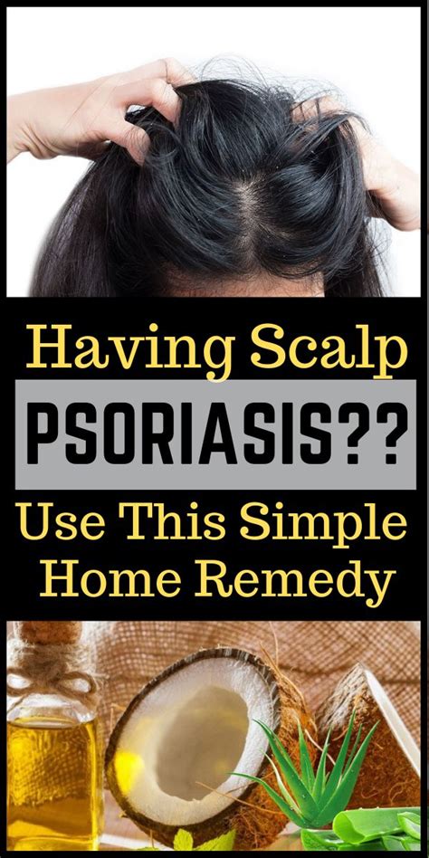 Home Remedies To Treat Scalp Psoriasis #scalpcare #itchyness # ...