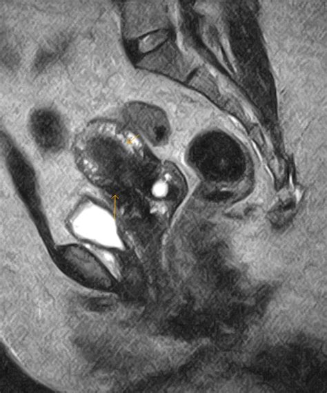 Adenomyosis-MRI - Sumer's Radiology Blog