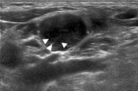 Supraclavicular Lymph Nodes Ultrasound - Ultrasound Of Superficial Lymph Nodes Sciencedirect ...