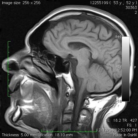 Resonancia Magnética Cerebro