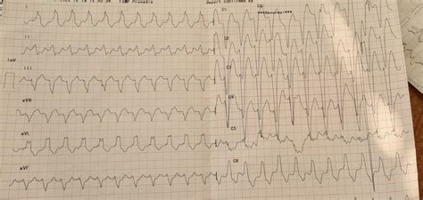 VT or not VT : r/ECG