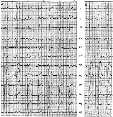 (A) ECG showing minimal preexcitation (rsR= pattern in lead III) only ...