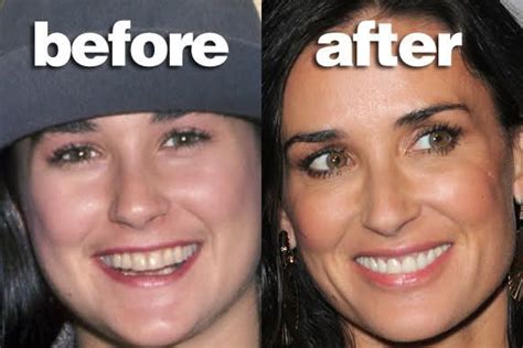 Makeover, what money can buy Celebrity Teeth, Celebrity Smiles, Veneers ...