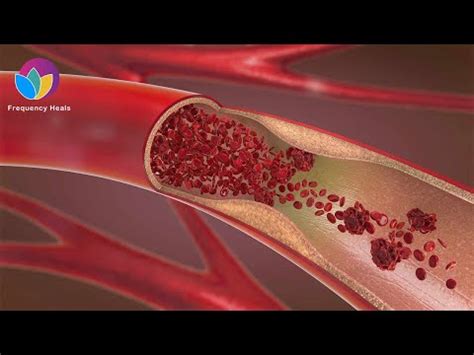 Artery Plaque Removal | Get Rid of Artery Plaque & Protect Heart and Brain Health - YouTube