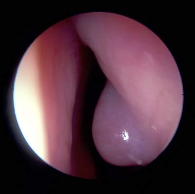 The nasal turbinates and turbinate reduction — Mr Daniel Tweedie - Consultant Paediatric ENT ...