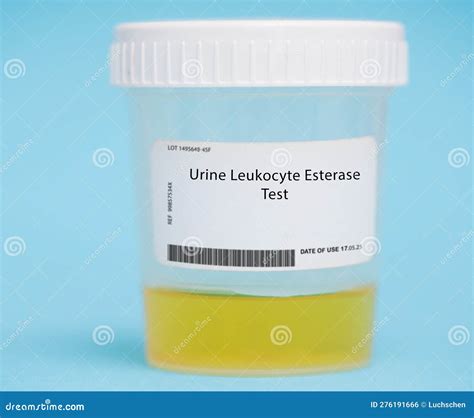 Urine Leukocyte Esterase Test Stock Photo - Image of cells, blood ...