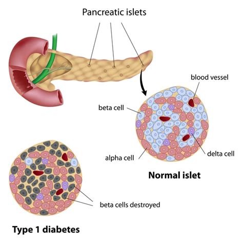 Type 1 diabetes: MedlinePlus Genetics