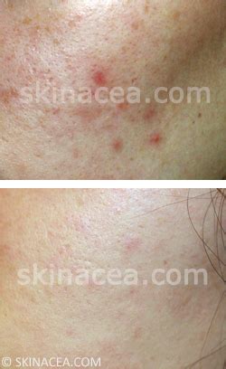 How to Fade Post-Acne Red Marks, Dark Spots, Pigmentation, Etc. | Skinacea.com