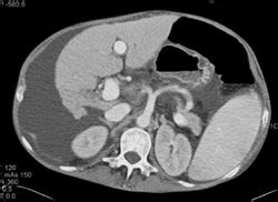 Cirrhosis - Liver Case Studies - CTisus CT Scanning