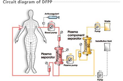 Double Filtration Plasmapheresis | Immune Cells 21