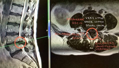 Spinal Stenosis - Spines Dorset