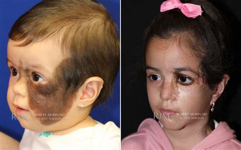 Giant Congenital Nevus Treatment | Hackensack