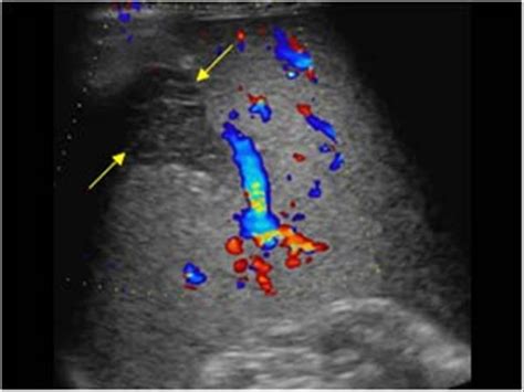 Abdomen and retroperitoneum | 1.4 Spleen : Case 1.4.3 Splenic infarcts | Ultrasound Cases