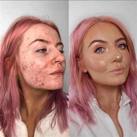 This foundation is going viral after cystic acne sufferer shares her 'insane' before-and-after ...