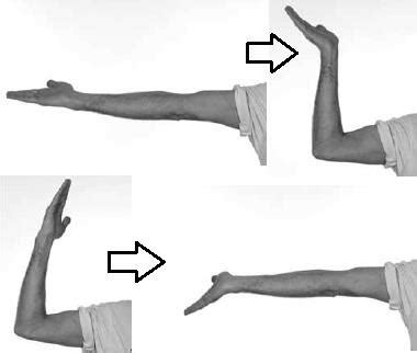 Cubital tunnel Syndrome