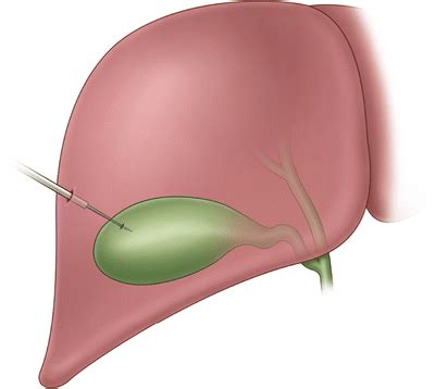 Percutaneous Cholecystostomy | Anesthesia Key