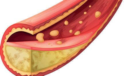 ¿Cómo se forman las placas de Ateroma y que puede suceder si avanza ...