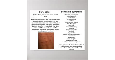 Bartonella Symptoms Educational Poster | Zazzle