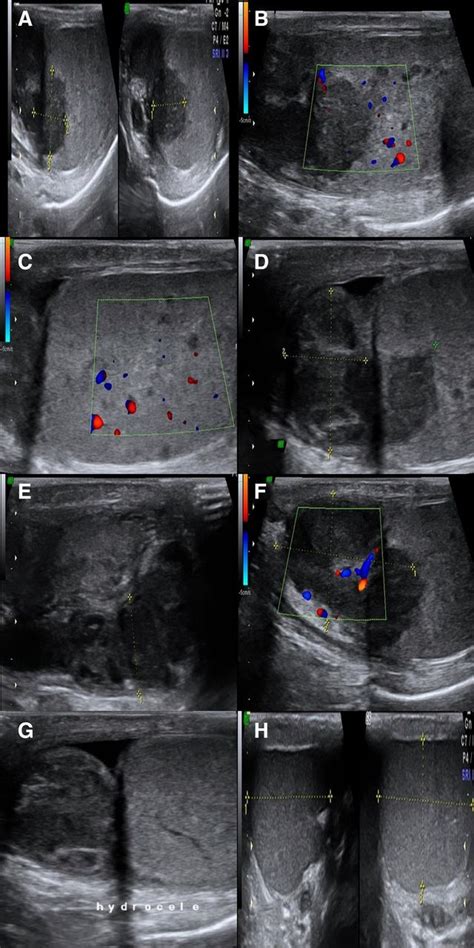 Hydrocele Ultrasound